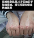 疫情期間，22歲醫(yī)護(hù)人員胡佩的手被消毒水和滑石粉浸泡侵蝕的傷痕累累