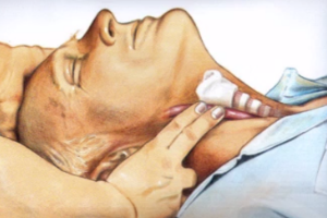 帶你了解心肺復蘇（<em>圖</em>1）