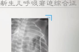 什么是新生兒呼吸窘迫綜合征？