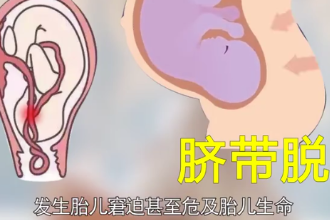 一分鐘了解臍帶脫垂
